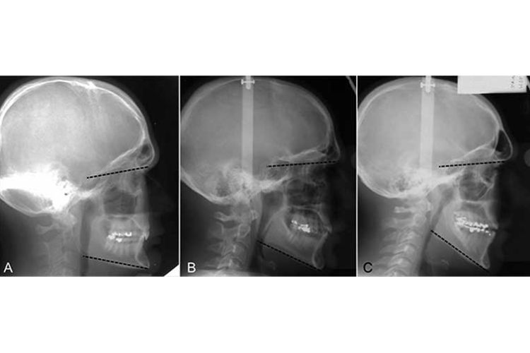 Predicting adult facial type from mandibular landmark data at 